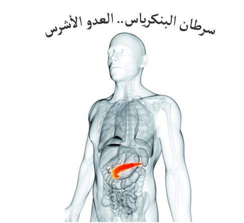 سرطان البنكرياس